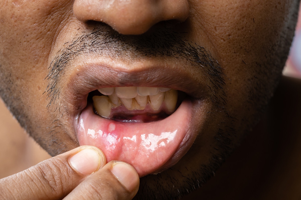 Caring for canker sores with over the counter products blog