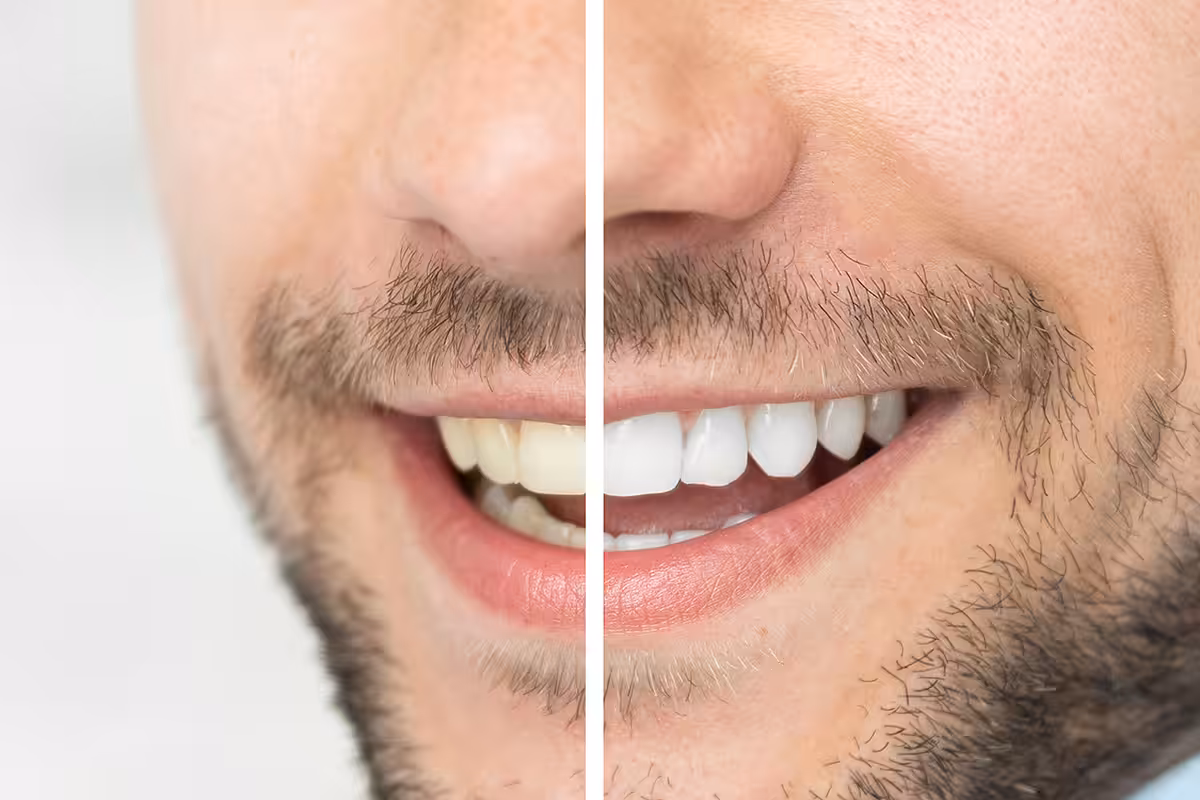In office vs at home teeth whitening which lasts longer blog