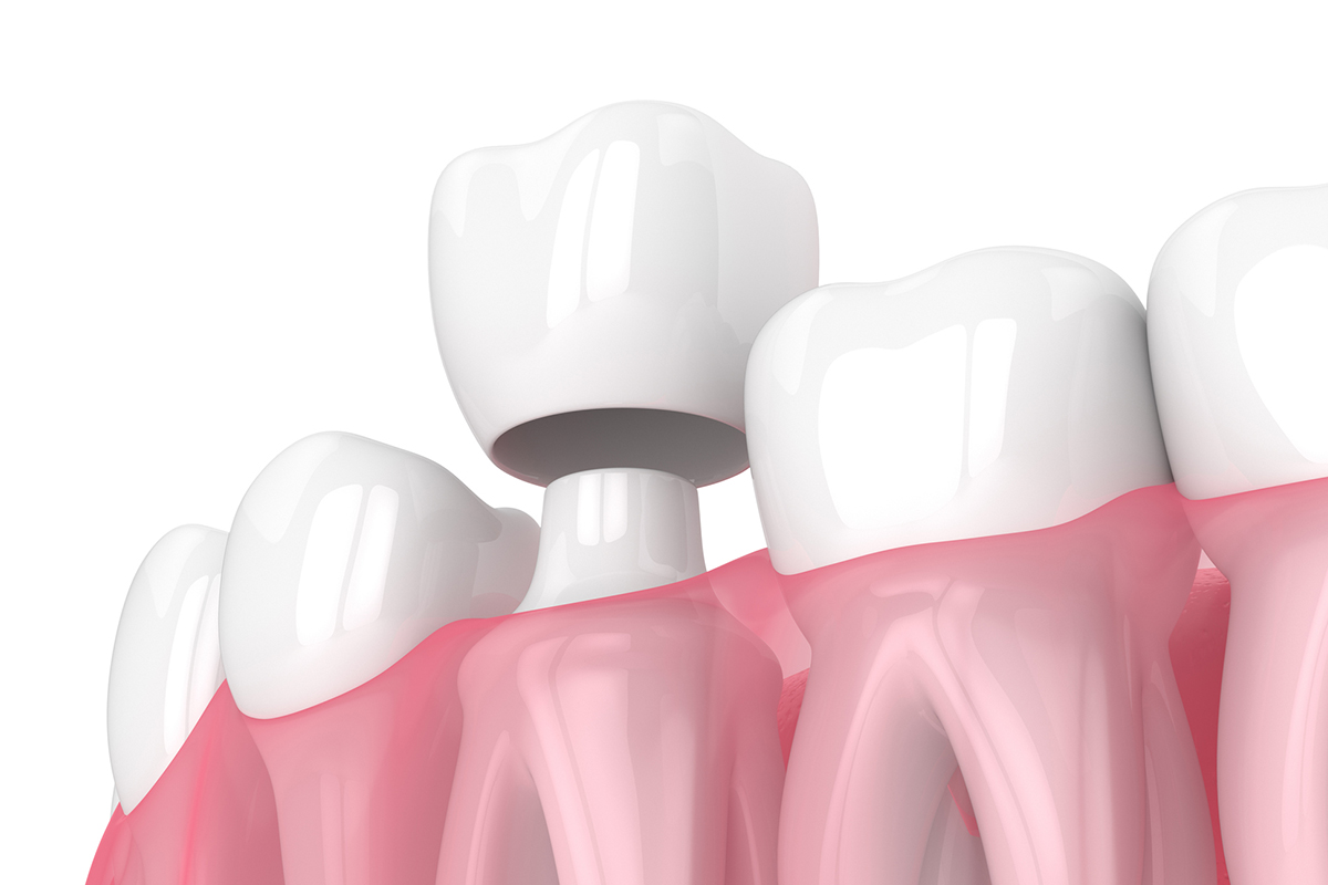 When do you need a dental crown signs to watch for
